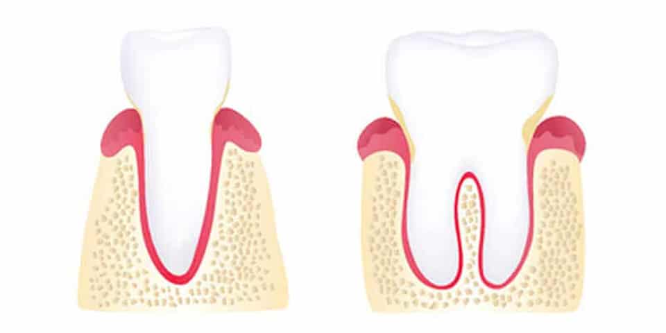 Gingivitis illustration