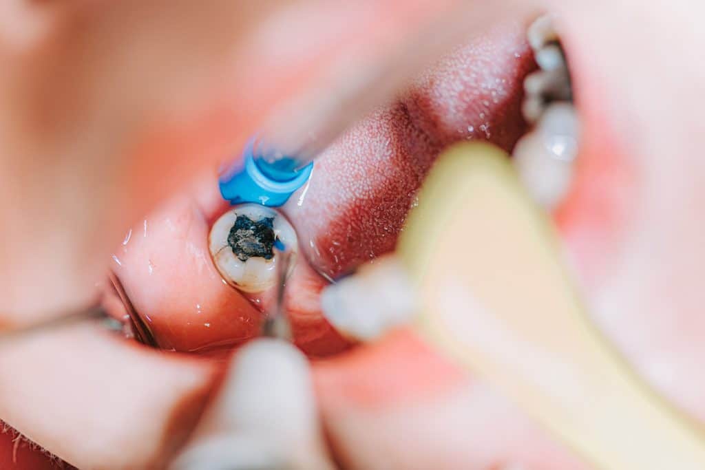 How Do You Tell If You Need A Root Canal?