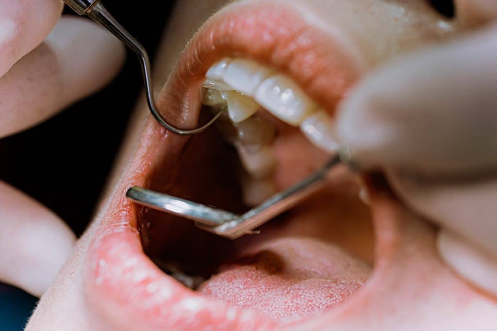 How Long Can You Go Without Getting A Root Canal?