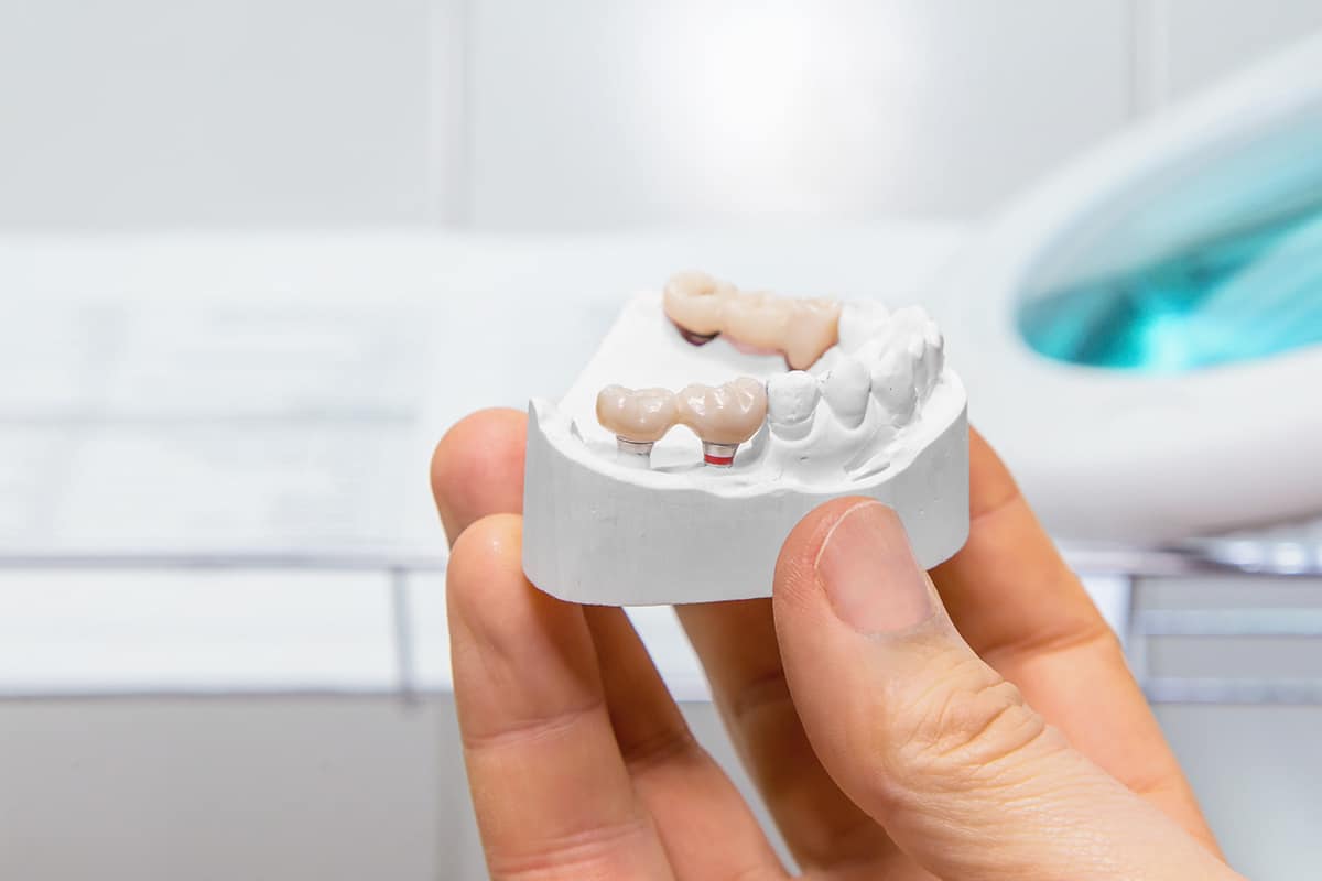 How Long Do Dental Bridges Last? Florida Dental Implant Center