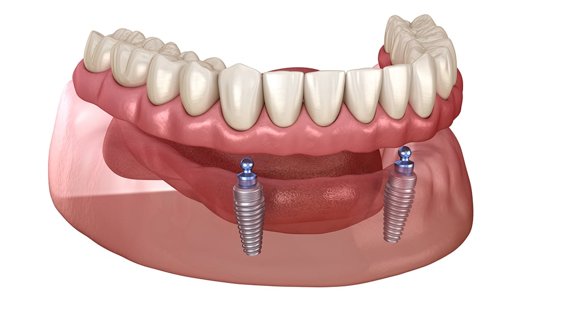 Implant Supported Dentures Graphic