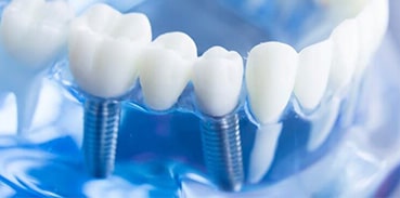 Dental Implants Image