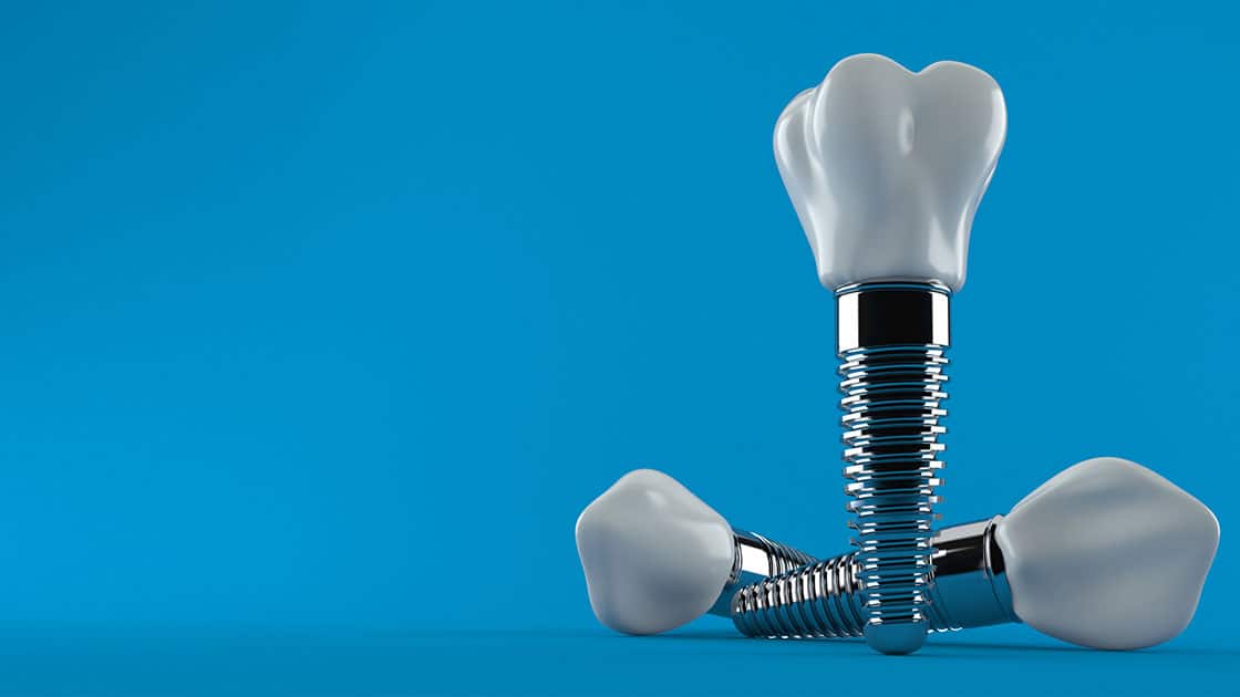 Dental Implants